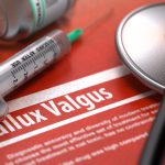 Hallux valgus